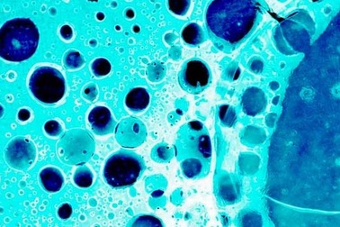 Mũi điện tử “ngửi” thấy nguy cơ ung thư dạ dày