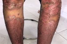Tự điều trị vảy nến, nữ bệnh nhân lở loét toàn thân