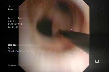 Clip lấy sỏi qua đường hầm Kehr