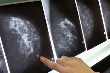 Giảm hơn 30% kích thước u vú bằng curcumin