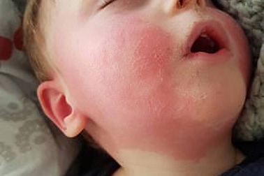 Anh: Trẻ mắc căn bệnh bí ẩn liên quan đến Covid-19 đều không có bệnh lý nền