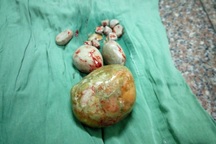 Cụ bà 84 tuổi mang trong người viên sỏi bàng quang to bằng quả trứng ngỗng