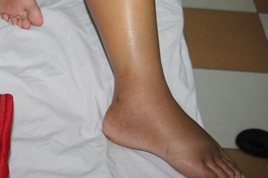 Dân bất an vì nhiều người bị rắn lục đuôi đỏ cắn sau lũ