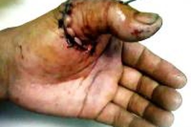 Nối thành công ngón tay cái bị đứt gần lìa do chặt cây