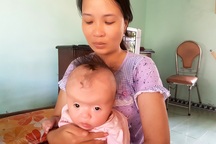 Thương bé 7 tháng tuổi mắc hội chứng Apert hiếm gặp