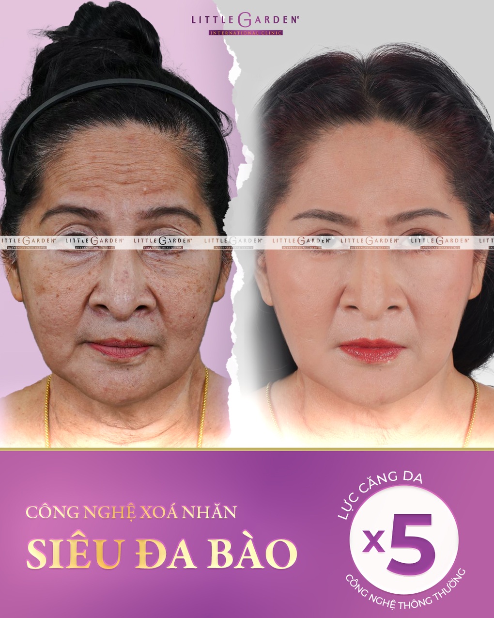 Tìm lại thanh xuân ngay và luôn bằng công nghệ xóa nhăn siêu đa bào - 3 Tìm lại thanh xuân ngay và luôn bằng công nghệ xóa nhăn siêu đa bào - 3