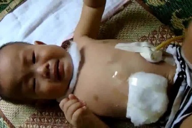 Clip: Tiếng khóc xé lòng của cháu bé 11 tháng tuổi bị teo thực quản và không có hậu môn