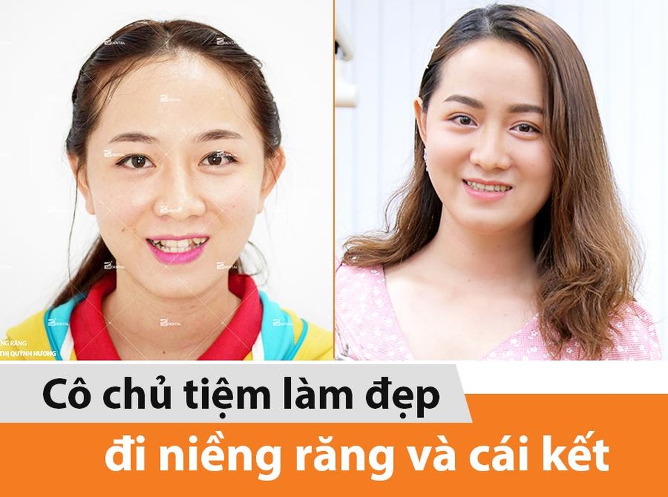 Quy trình niềng răng: Ngoạn mục cô chủ tiệm làm đẹp thay đổi sau 2 năm đeo niềng - 1