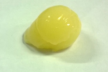 Một bé 5 tuổi hôn mê vì hóc thạch