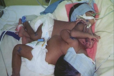 Tách thành công trẻ song sinh non tháng, nhẹ cân, dính ngực bụng