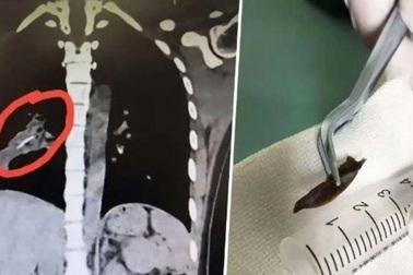 Ho suốt 14 năm mới biết bị mắc kẹt xương gà… trong phổi