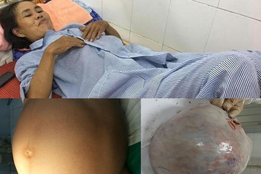 Nghe lời thầy bói, “mang thai” khối u 10kg suốt 9 tháng