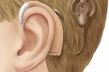 Trẻ khiếm thính nên được phẫu thuật cấy ốc tai trước 18 tháng tuổi