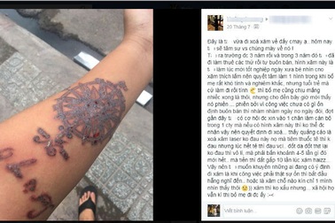 Xóa hình xăm vì khó tìm việc, chàng trai khuyên bạn trẻ "nghĩ kĩ rồi mới xăm"