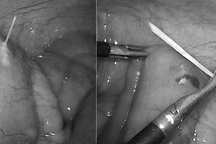 Sau ăn phở, người phụ nữ Hà Nội nhập viện cấp cứu vì vật quen thuộc này