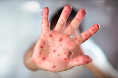 Đồng Nai ghi nhận ca tử vong đầu tiên do bệnh sởi