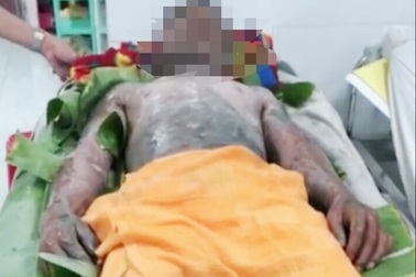 Đang ăn cơm, bếp gas mini bất ngờ phát nổ khiến nam thanh niên bị bỏng nặng