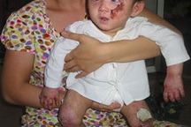 Thương vô cùng bé 13 tháng tuổi bị bệnh “lột da ếch”