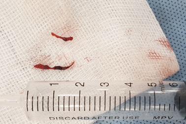 Nhồi máu cơ tim cấp vì uống nước ngọt liên tục