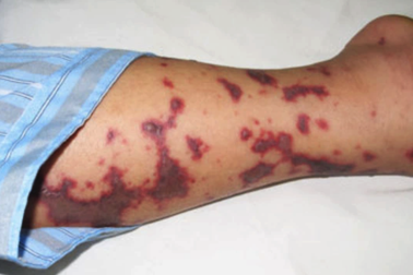 Đối phó với căn bệnh gây nhiễm trùng huyết, 135.000 ca tử vong/năm thế nào?