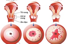 Mắc ung thư cổ tử cung sống được bao lâu?