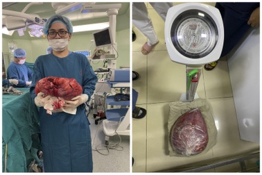 Sốc: Khối u 10kg trong bụng nữ bệnh nhân