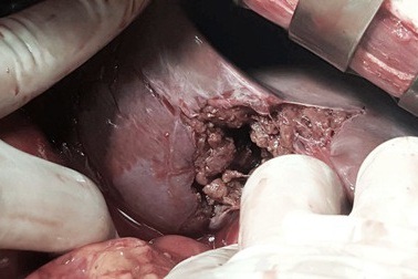 Cứu sống bệnh nhân vỡ gan, dập ruột mất máu cấp