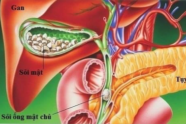 5 triệu chứng cảnh báo sỏi túi mật bạn cần biết