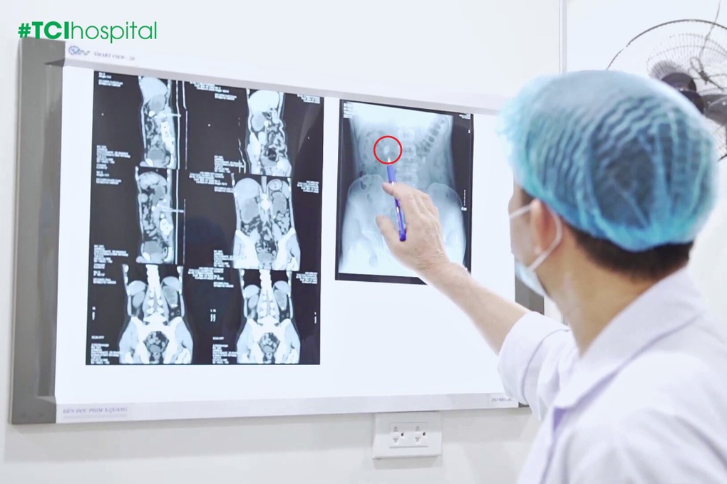 Cứu hai quả thận khỏi bờ vực suy thận từ biến chứng giãn nặng - 2 Cứu hai quả thận khỏi bờ vực suy thận từ biến chứng giãn nặng - 2