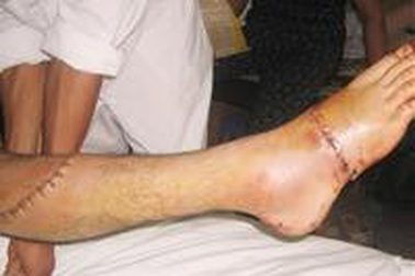 Nối thành công bàn chân bị chặt đứt rời