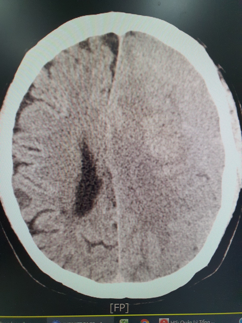 Hà Nội: Người đàn ông hôn mê vì uống an cung ngưu hoàng ngừa tai biến não - 1