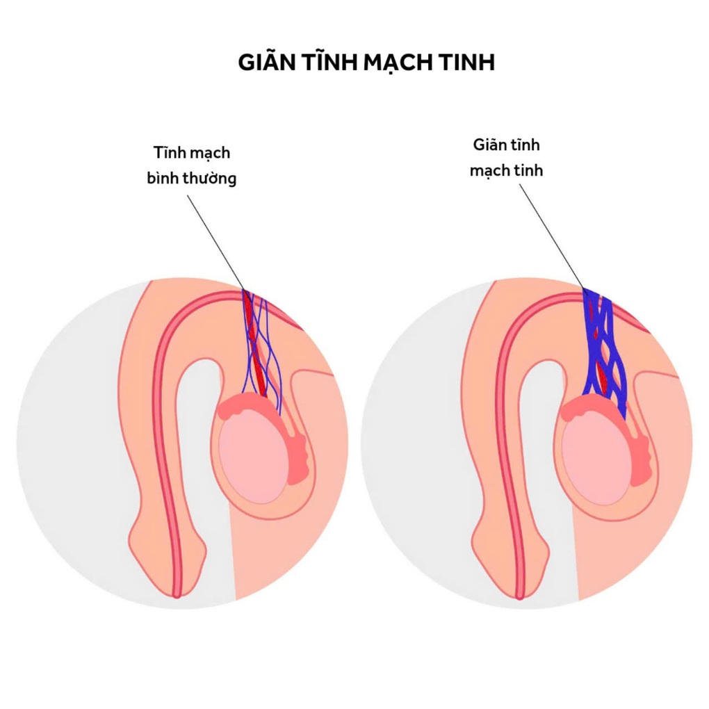 Suýt mất cơ hội làm cha vì căn bệnh gây hiếm muộn phổ biến ở nam giới - 1