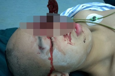 Sống sót thần kỳ dù bị lưỡi cưa găm vào đầu