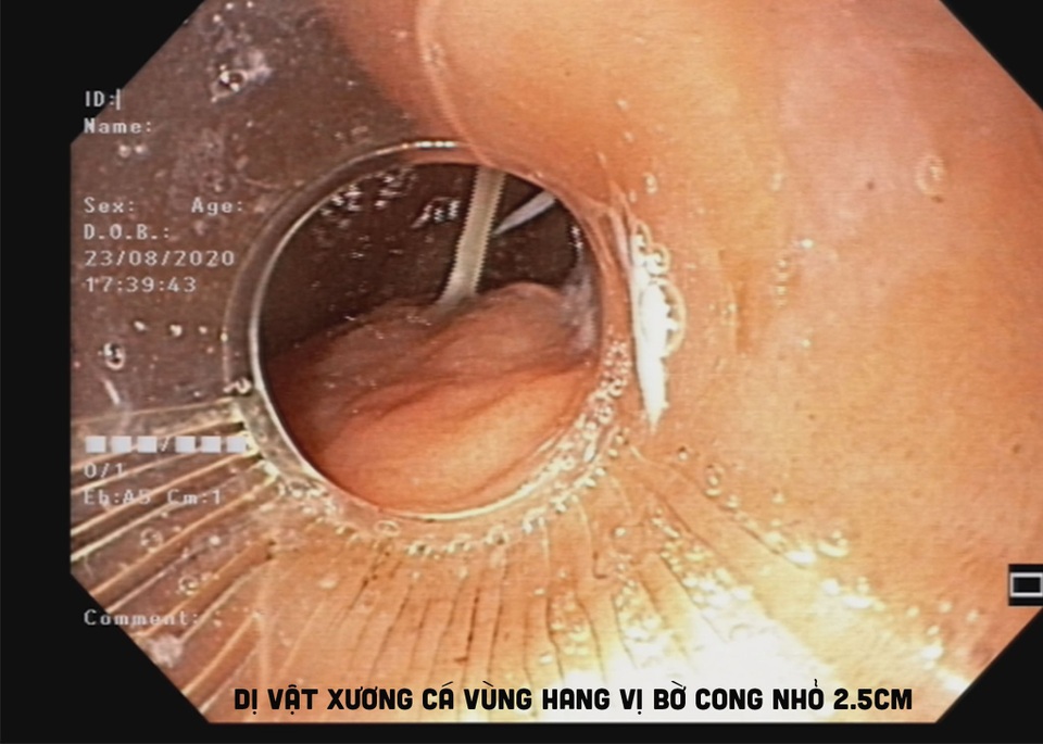 2 chiếc xương cá cùng đâm vào dạ dày - 1