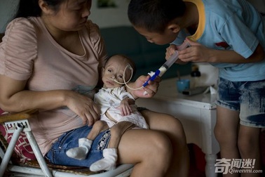 Mắc bệnh lạ, bé gái Trung Quốc 1 tuổi chỉ nặng chưa đầy 3 kg