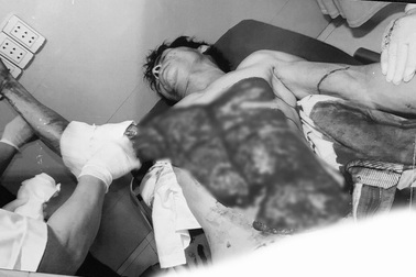 Kinh hoàng ngực, bụng bệnh nhân đỏ lòm vì bị máy bóc gỗ lột tung da