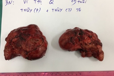 Phẫu thuật "giải thoát" cho cụ bà khỏi những khối u "siêu khổng lồ"