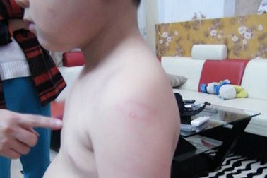 Đình chỉ giáo viên mầm non phạt học sinh bầm tím người