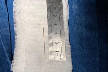 Gắp thành công kim đâm xuyên thành ngực cứu bệnh nhi 3 tuổi