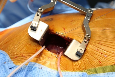 Ca mổ tim ít xâm lấn đầu tiên tại bệnh viện tuyến quận