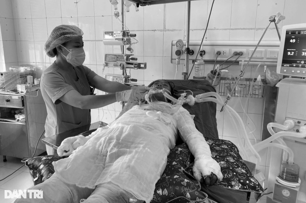 Người đàn ông bị bỏng 85% cơ thể đã không vượt qua được số phận - 1 Người đàn ông bị bỏng 85% cơ thể đã không vượt qua được số phận - 1