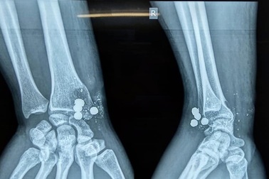 Nam thanh niên nghịch súng kíp, 5 viên đạn nổ găm vào cổ tay