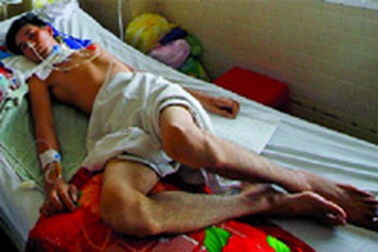 Liệt toàn thân sau tiêm phòng dại!