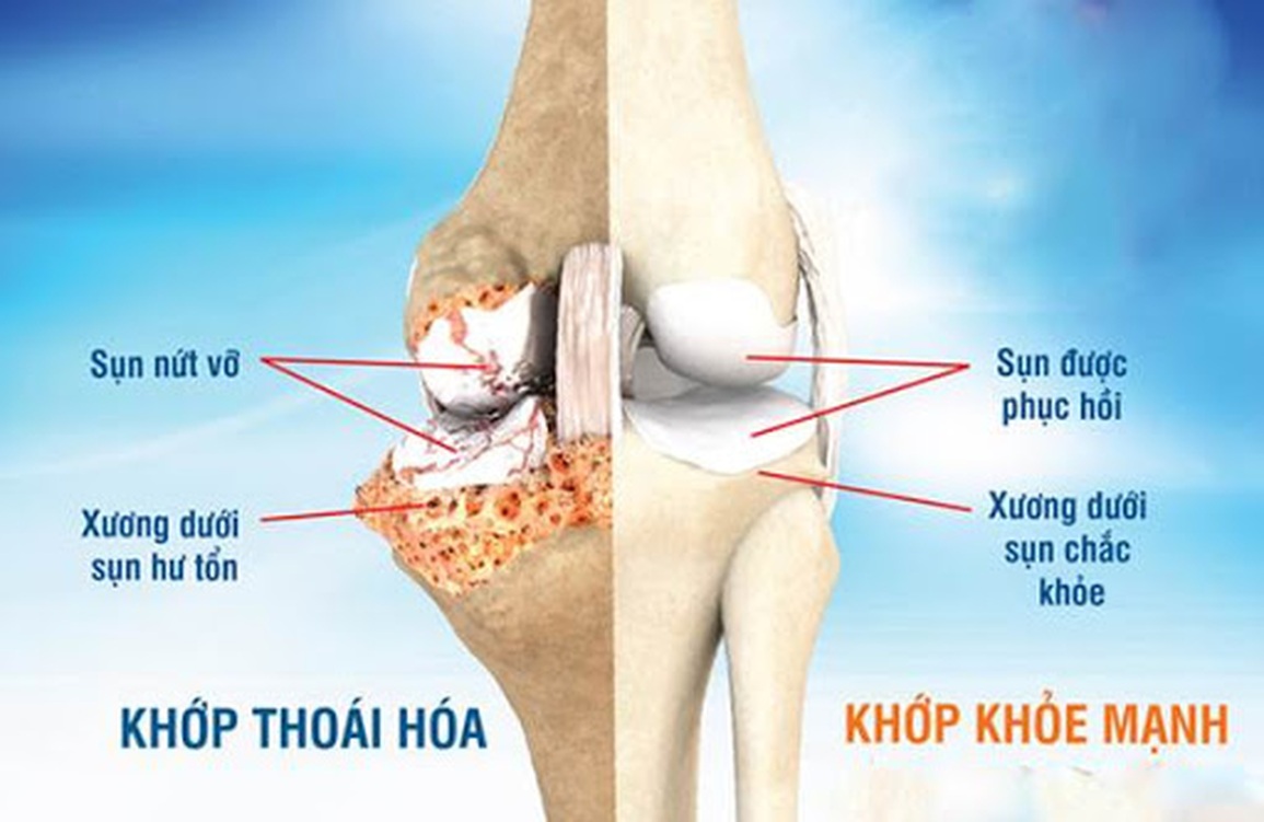 Bộ sản phẩm KYOKA - UPP66 - XS2 hỗ trợ hiệu quả cho bệnh nhân thoái hóa khớp - 1 Bộ sản phẩm KYOKA - UPP66 - XS2 hỗ trợ hiệu quả cho bệnh nhân thoái hóa khớp - 1