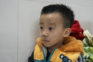 Cả mẹ và con nhập viện vì thủy đậu