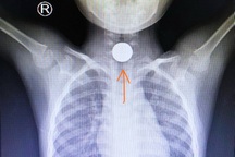 Nuốt đồng xu khi đi chúc Tết, bé trai 5 tuổi mắc nghẹn nguy kịch