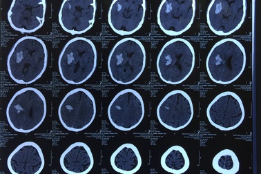 Phát hiện chảy máu não sau 1 tuần bỗng nhiên đau đầu, nói ngọng