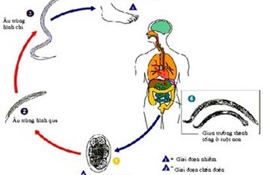 23 người ăn thịt trăn bị nhiễm giun móc hay giun xoắn?