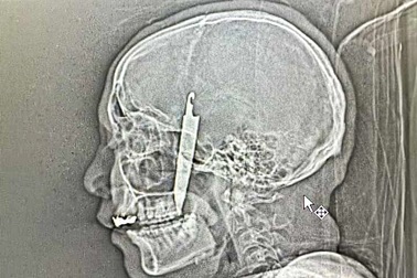 Cứu sống nam thanh niên bị đâm dao vào đầu