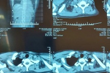 Cô gái 19 tuổi ở Hà Nội bị khối u quái to 20cm đè bẹp phổi